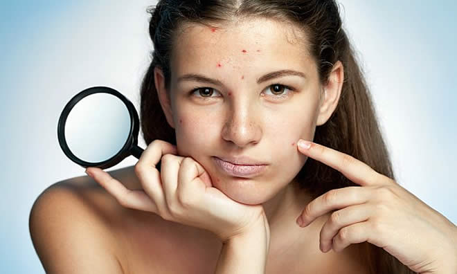 Diet To Stay Away Acne